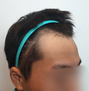 수술전 완벽한 m자였습니다