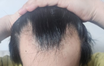 모발이식전