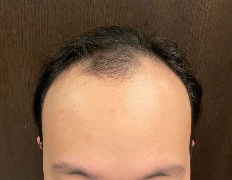 植毛から1年が経ってみると、はっきりとした違いが感じられます