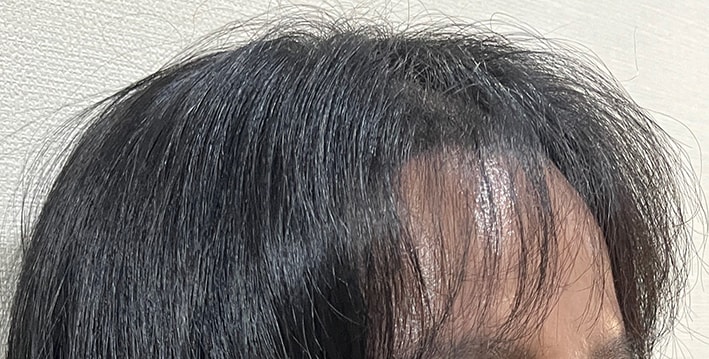 13일 앞머리로 가렸을때 옆모습이에요