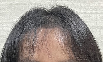 13일 앞머리로 가렸을때 앞모습이에요