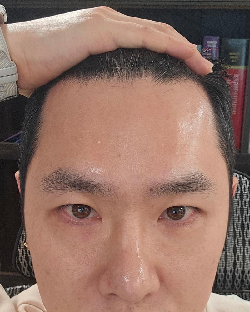 I'd like to have an M-shaped hair transplant