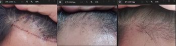 수술전 암흑기 엊그제 왼쪽
