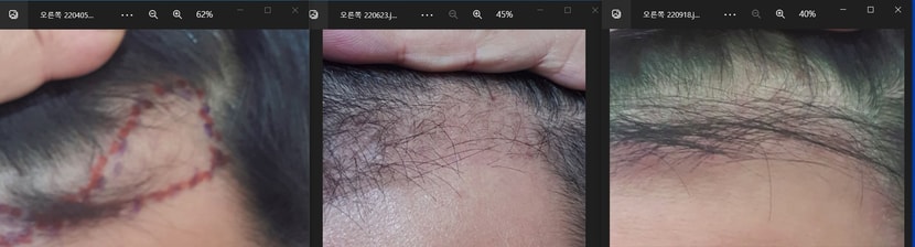 수술전 암흑기 엊그제 오른쪽