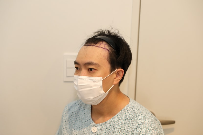 모발이식전 촬영입니다.