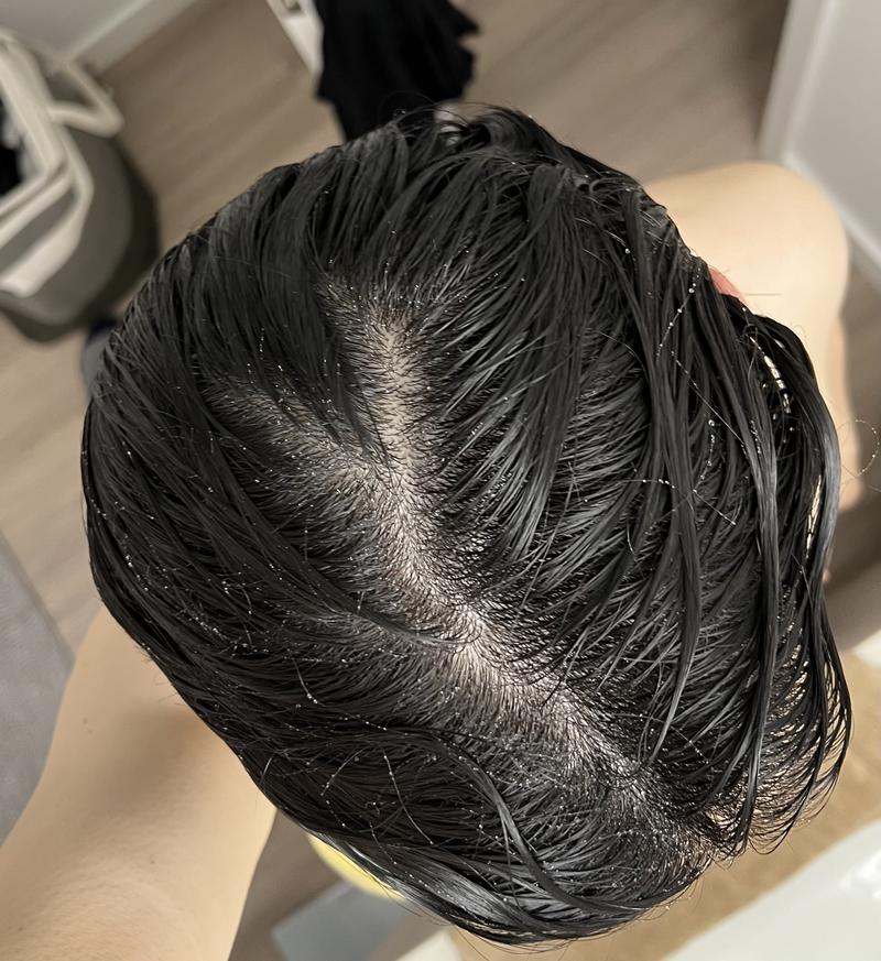 모발이식 병원 추천