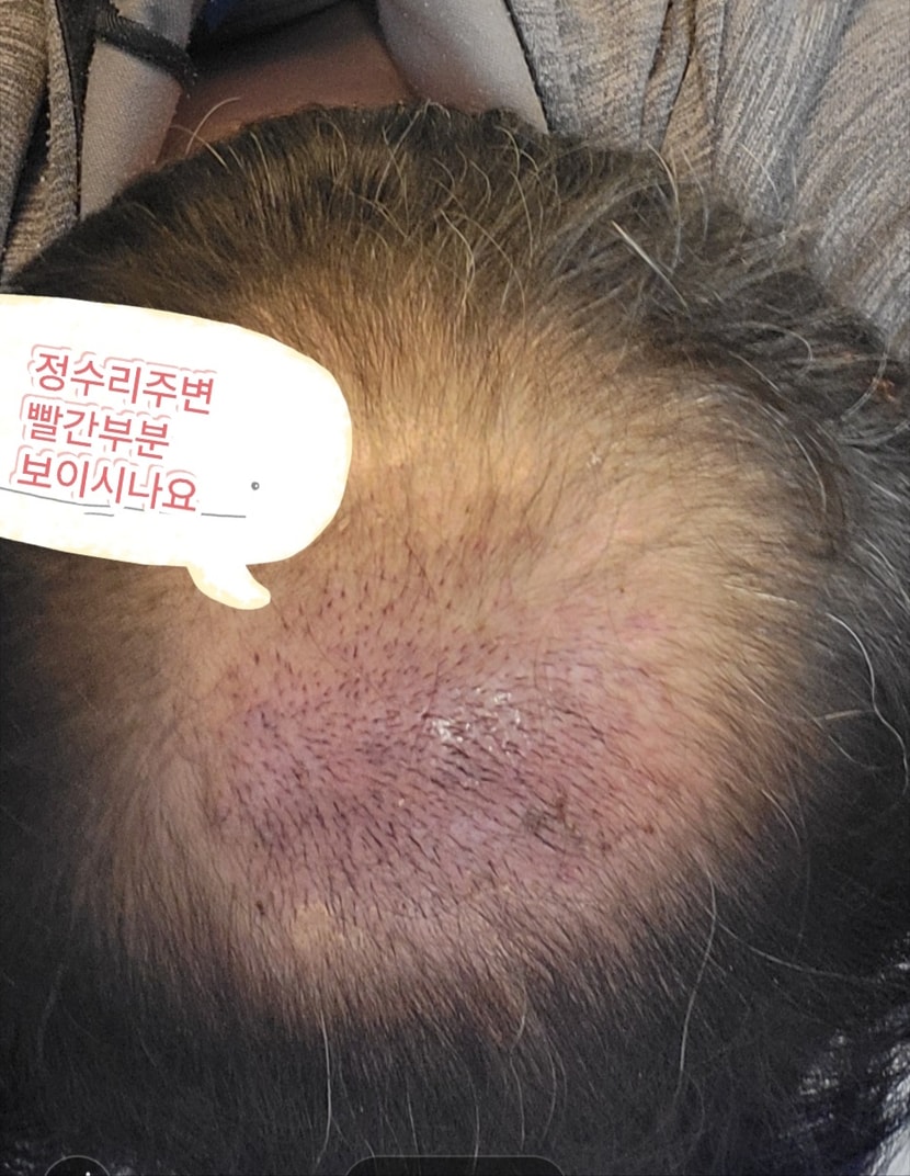 정수리쪽으로 약1500모이식된곳