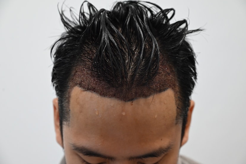 수술후 2일차