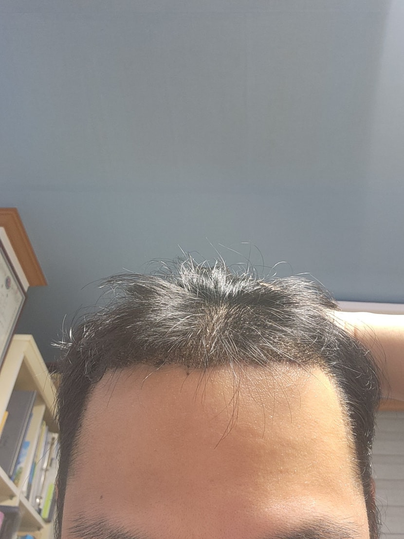 수술후 8일차