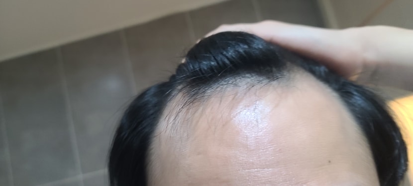 이식전