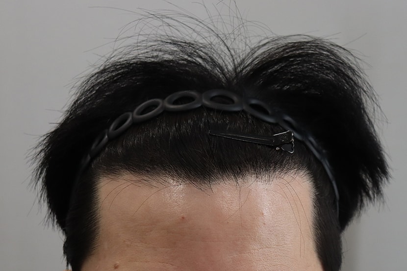 수술후1