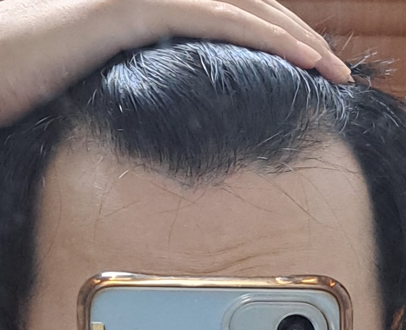 수술전