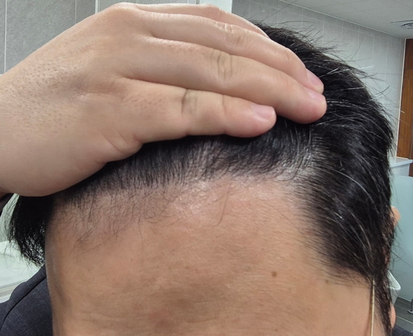 수술후