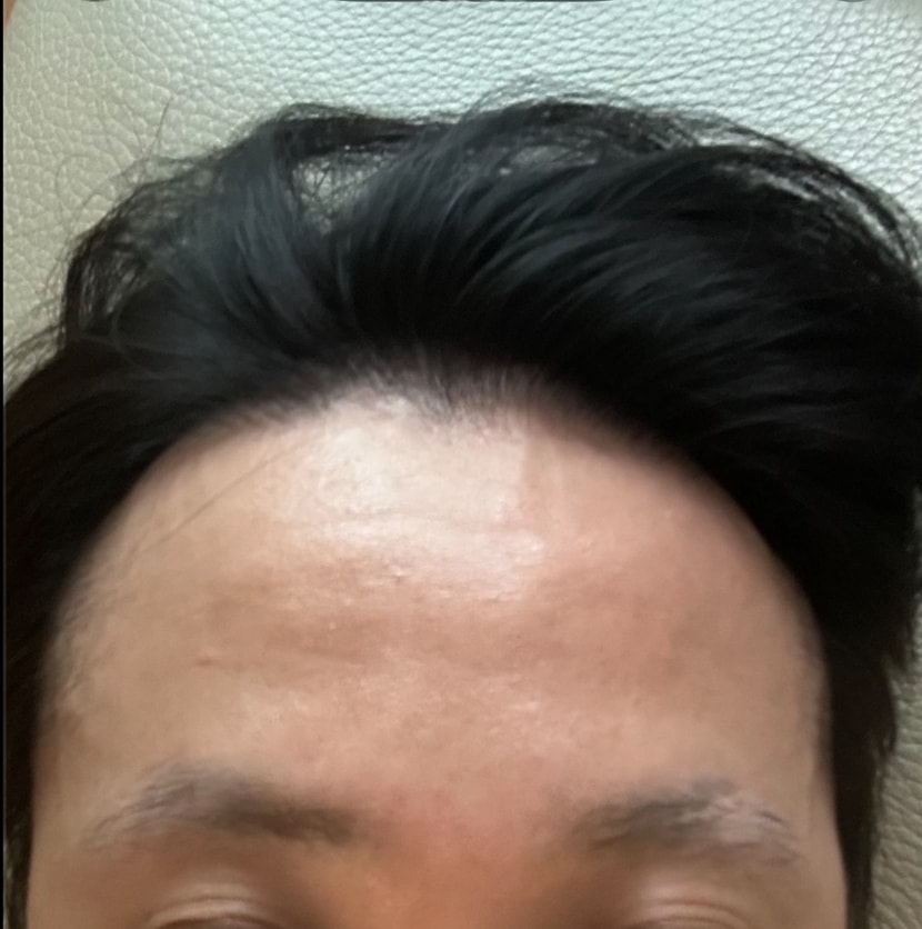 모발이식 5개월전