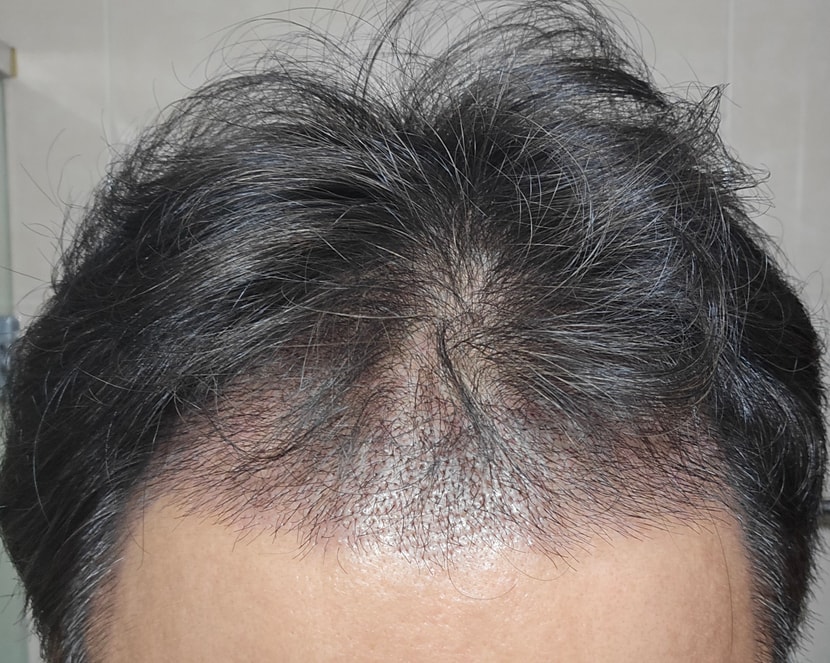 수술후 20일경과