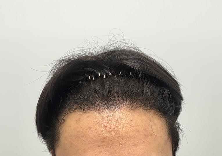 이식 후