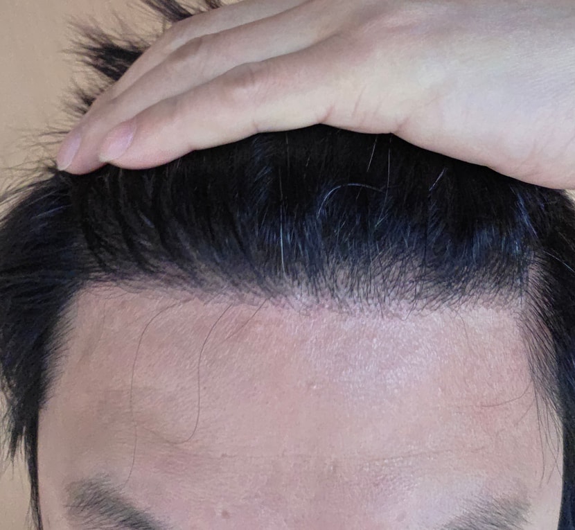 1300모낭 8개월차