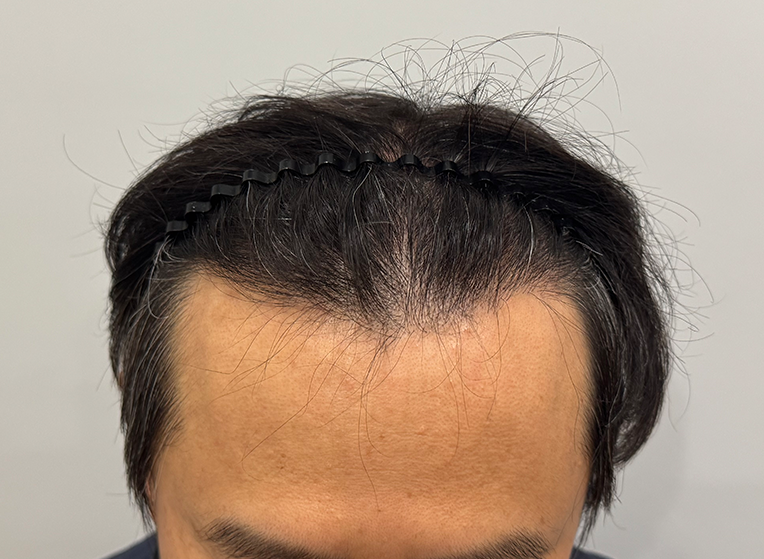 후