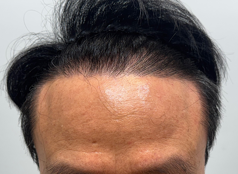 후