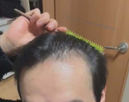 수술전