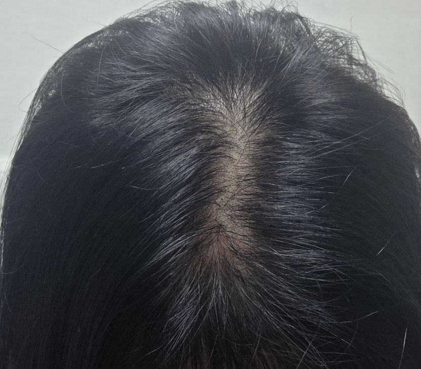 수술전