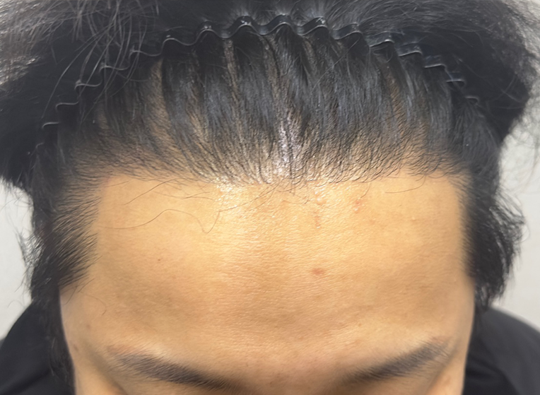 후