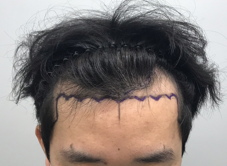 전