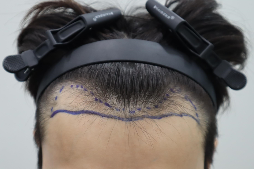 수술 전