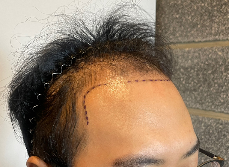 전