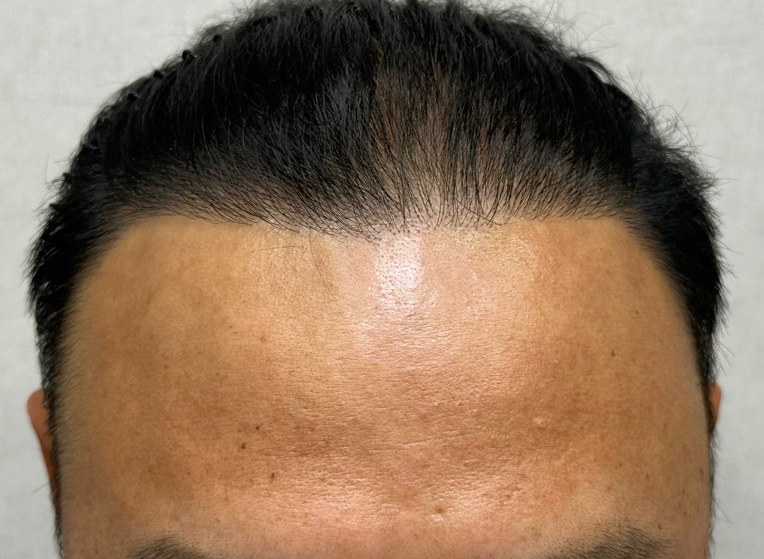 후