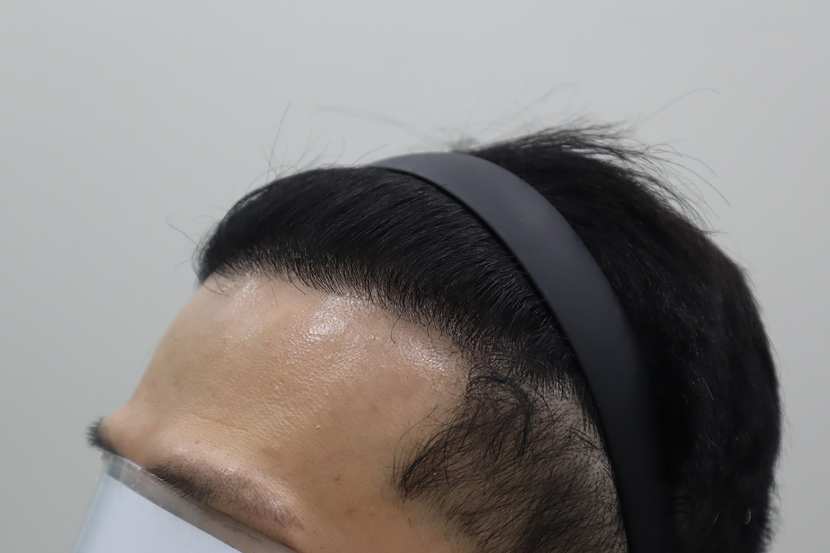 1년 경과보러 병원 다녀온 후 