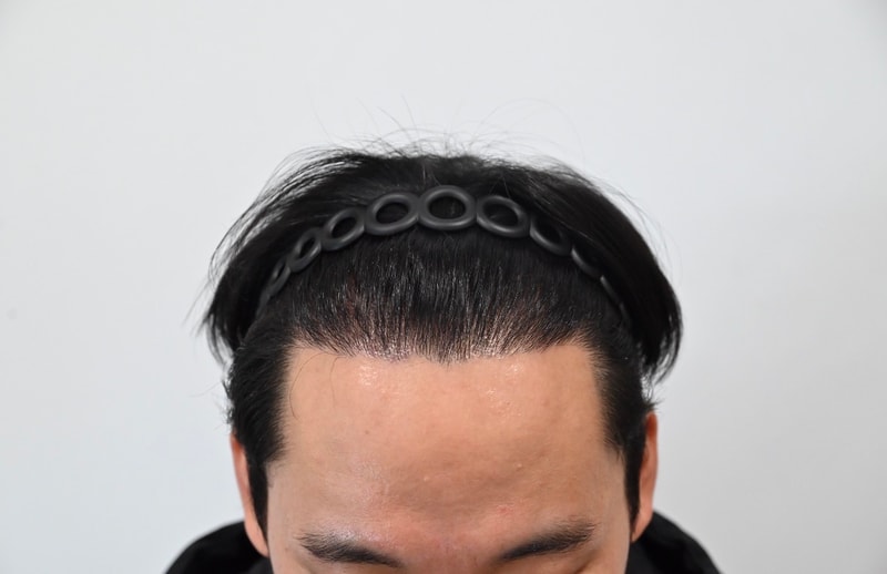 모발이식