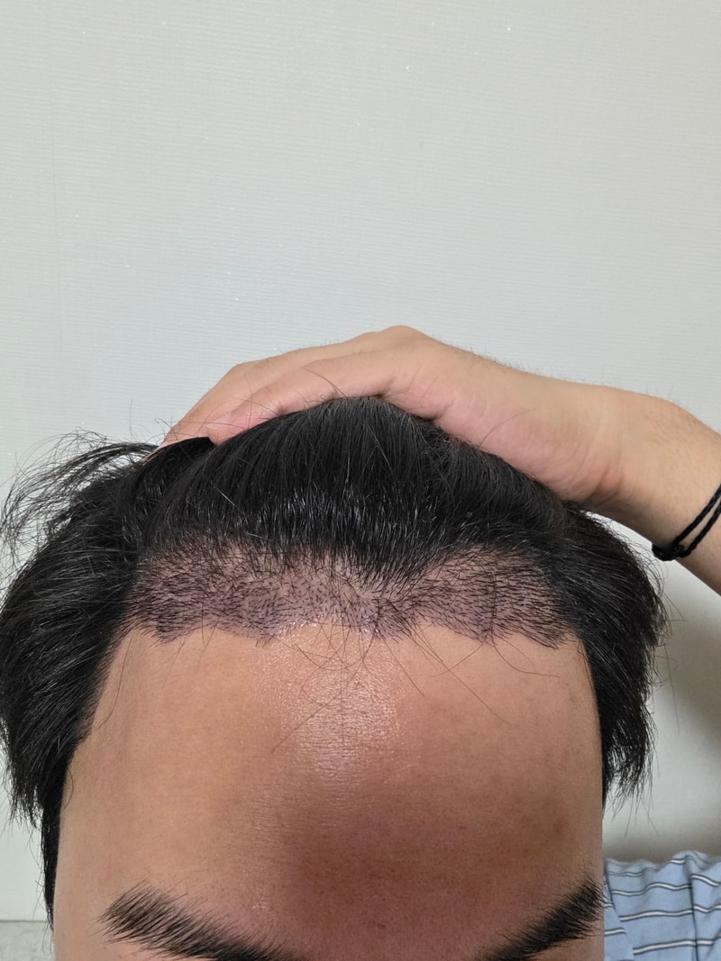 모발이식