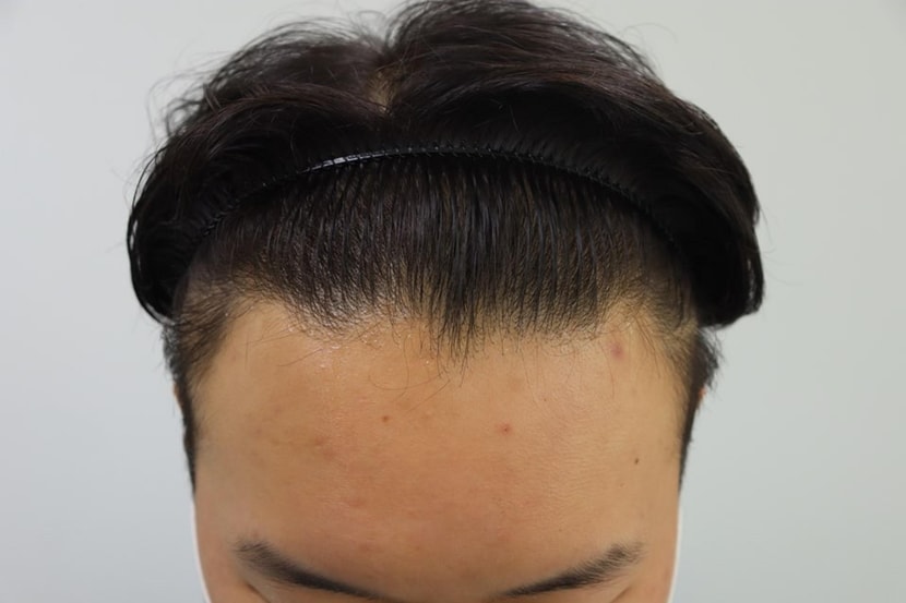 수술전