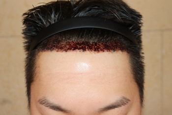 이식전