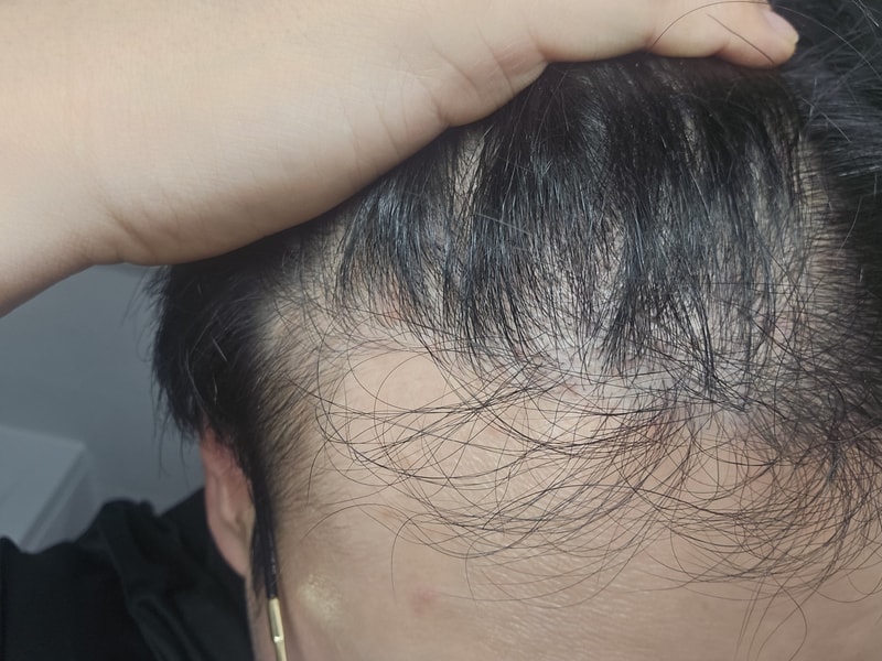 毛发移植8个月后