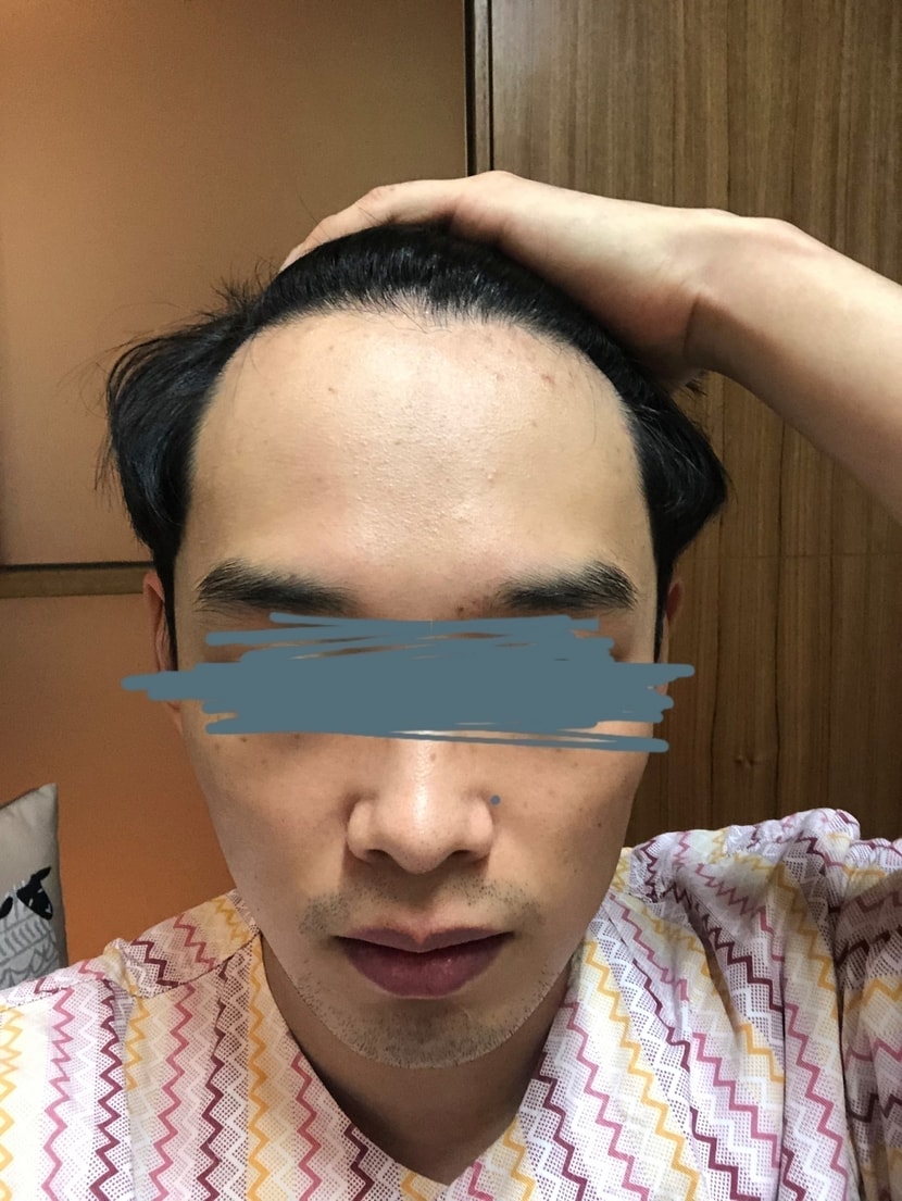 모발이식 전
