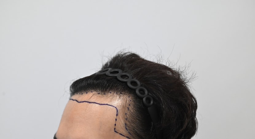 수술전