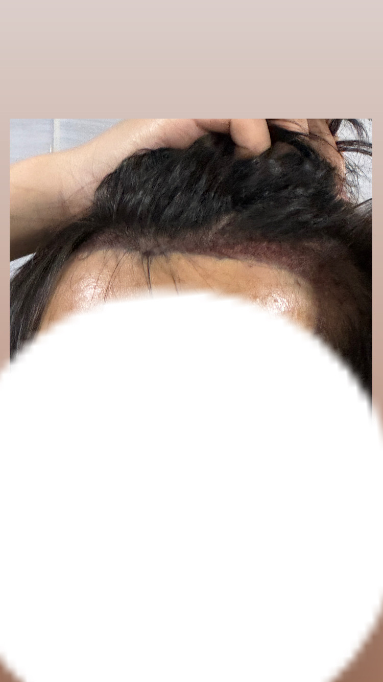 수술 다음날입니다