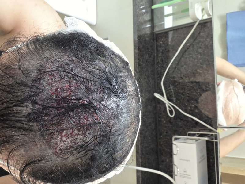 釜山Momo议员毛发移植