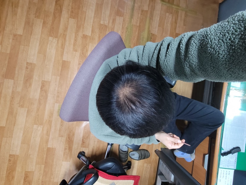 모발이식 7개월