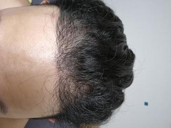 3월5일에 수술 받고 이제 거의 8개월차가 되어가네요 