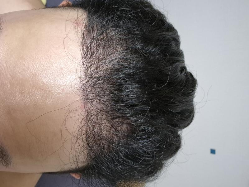 모발이식 거의 8개월차 되가는데 밀도가 이게..어떤지 냉정히 평가해주세요