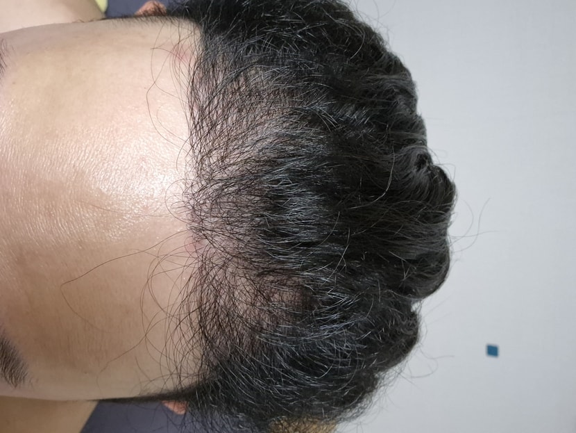3월5일에 수술 받고 이제 거의 8개월차가 되어가네요 
