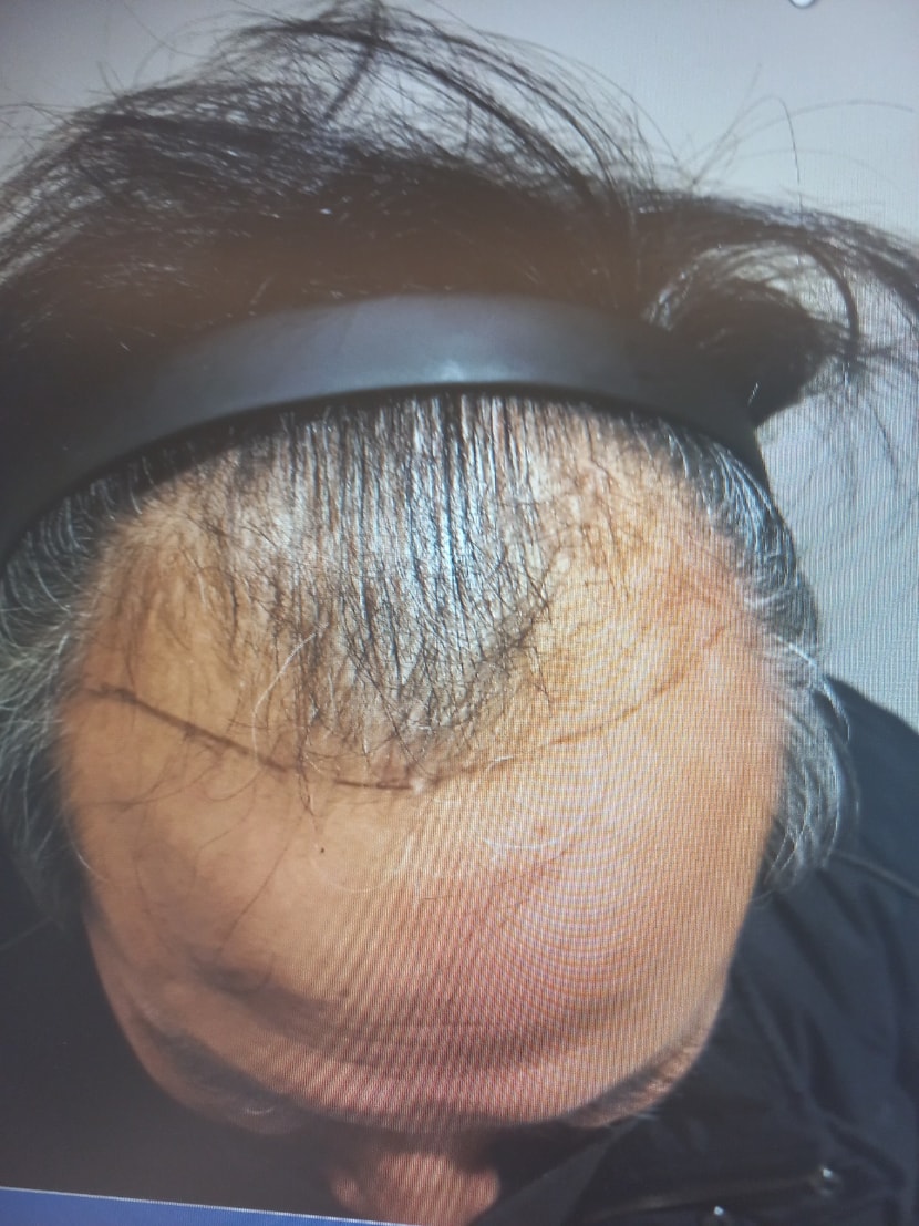 견적 당시 M자머리