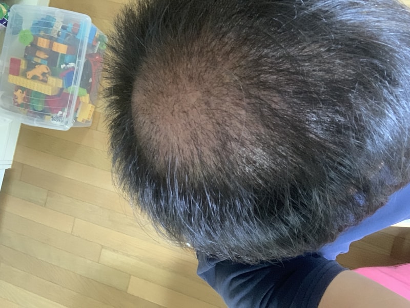 毛发移植后记 – 毛在成整形外科/1天到1年间的真实记录