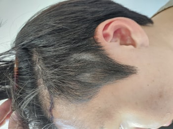 수술후입니다 앞으로 관리를 잘해야겠네요
