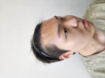 수술전입니다 수술흉터입니다 그리고 헤어라인도 좀하려고요
