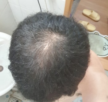 모발이식 전