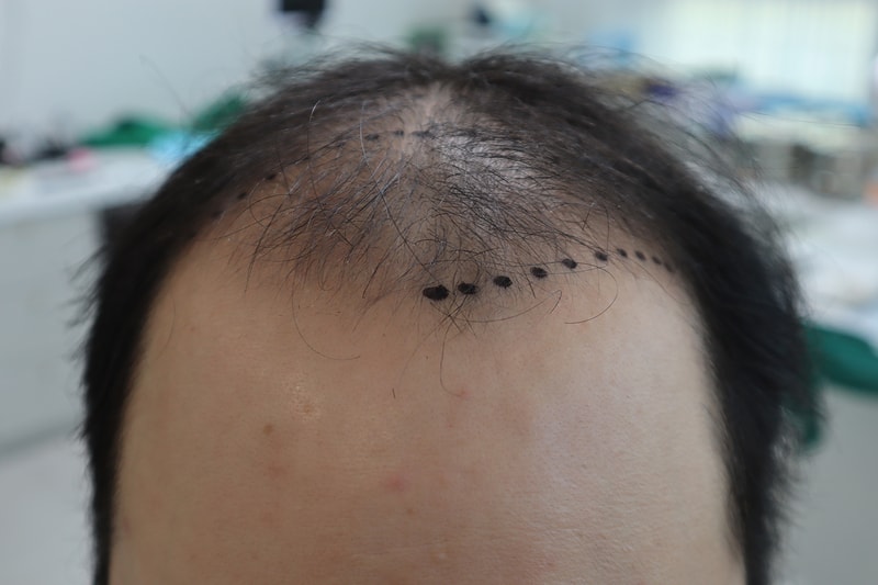 非切开5600头移植最终1年后期。